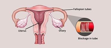 Best IVF Centre in Aundh